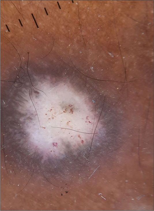 Majocchi’s granuloma following steroid application - Journal of Skin ...