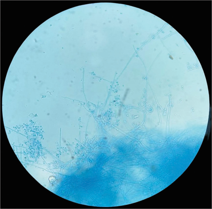 Lactophenol cotton blue tease mount showing microconidia, macroconidia, and spiral hyphae (×100).