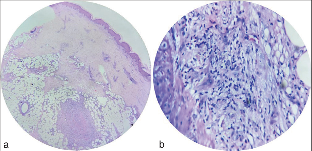 Punch biopsy from skin nodule (a): Scanner view (Hematoxylin and Eosin stain) showing septal panniculitis (H&E 4×); (b): High power view (Hematoxylin and Eosin stain) showing inflammatory infiltrate of neutrophils, epithelioid cells and multinucleate giant cells with septal panniculitis (H&E ×40).