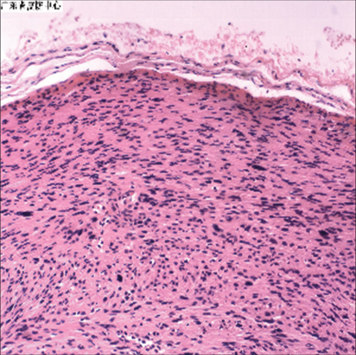 The boundary of the tumor is clear, and the spindle cells are braided arranged H & E ×100. Microscopic section shows that the nodules were well delineated and consisted of interlacing bundles of spindle-shaped cells.