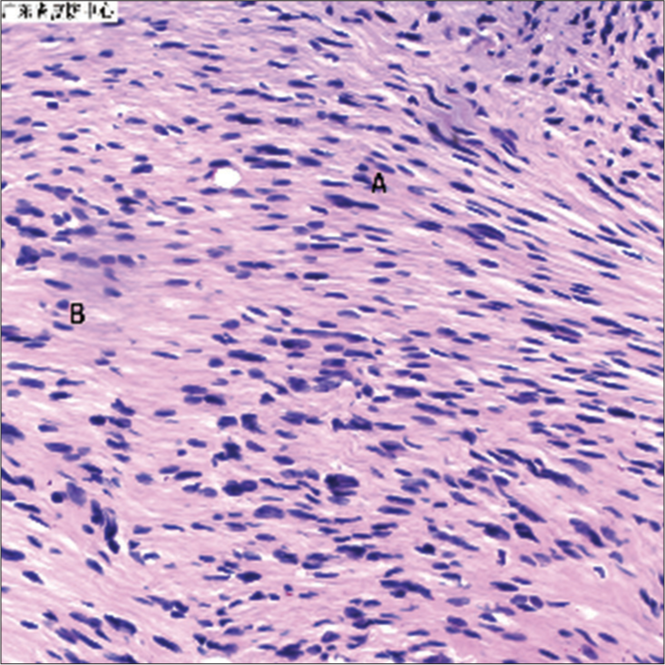 Antoni A tissue consists of high cellularity area. Foci of palisaded nuclei (Verocay bodies) are seen. Antoni B tissue shows low cellularity of spindle cells on myxoid stroma. Hematoxylin and Eosin (HE) ×400.