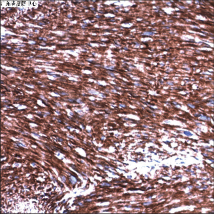 Vimentin (+), intracellular expression of tumor (×400).