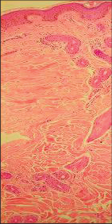 Homogenous dermal hyalinization with scattered eccrine glands over the affected side (Eosin and hematoxylin stain, ×40 magnification).