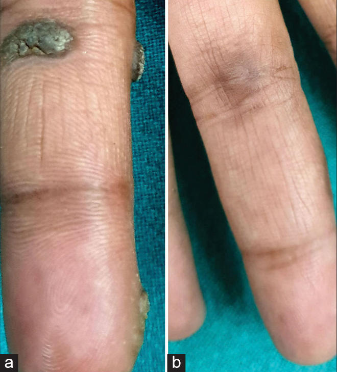 (a) Palmar wart at baseline. (b) At 2 weeks after single sitting of intralesional bleomycin showing complete clearance with residual hyperpigmentation.