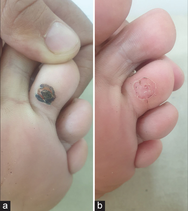 (a) Plantar wart showing Eschar formation post intralesional bleomycin. (b) Complete clearance of wart after paring.