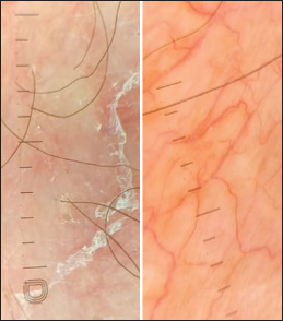 Dermoscopy showing diffuse erythema, white peripheral scales, serpentine, and branching vessels (using DermLite DL5, ×10 magnification, nonpolarized mode and polarized mode, respectively).