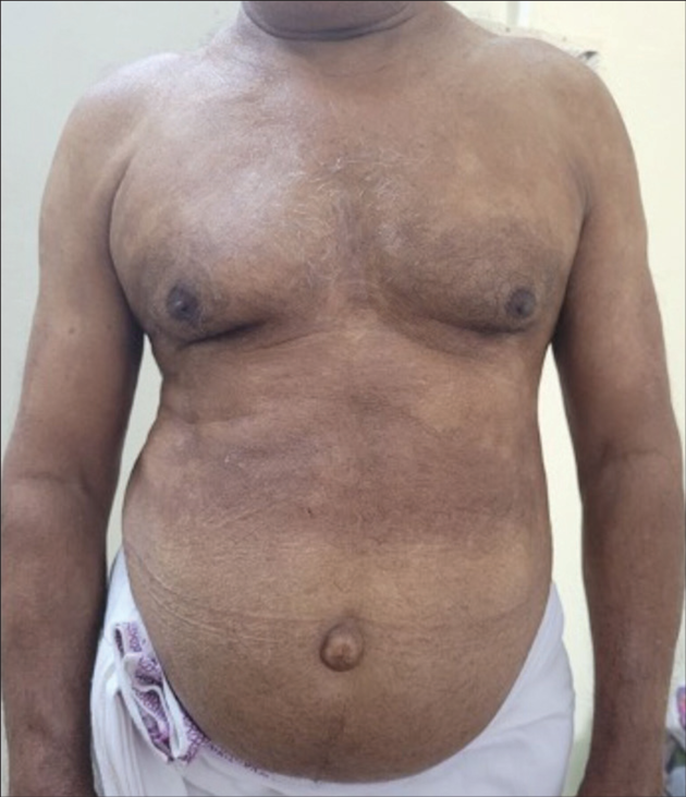 Multiple discrete and confluent hypopigmented macules with annular borders present over chest, abdomen, and upper limbs.