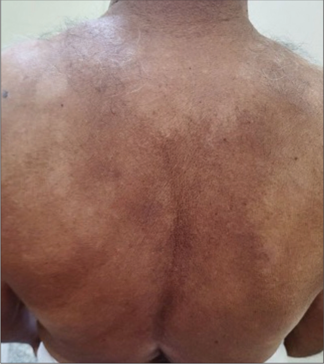 Multiple discrete and confluent hypopigmented macules with polycyclic borders present over back of trunk with islands of normal skin in between lesional skin.