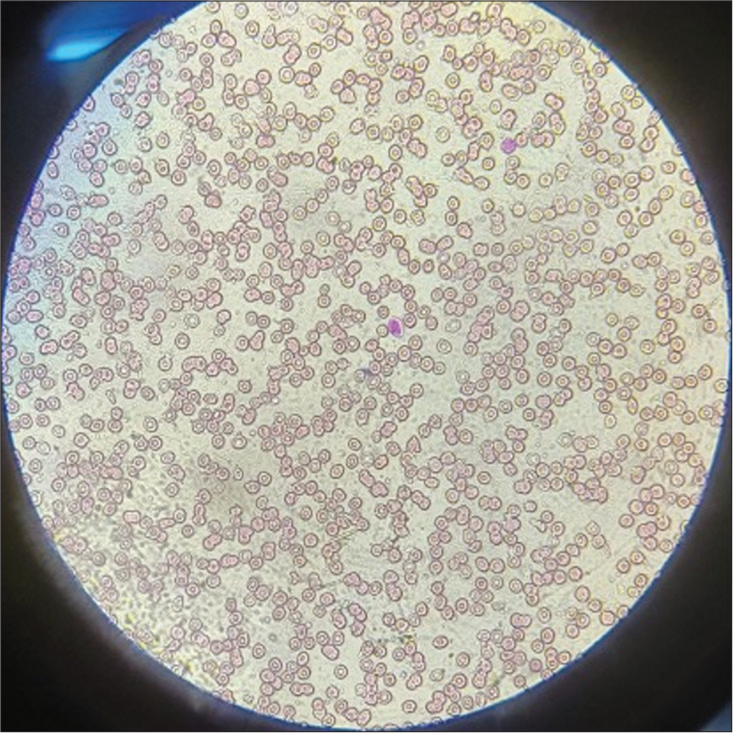 Peripheral smear showing anisopoikilocytosis, normocytic normochromic red blood cells with microcytes, tear drop cells, elliptocytes, and occasional target cells.