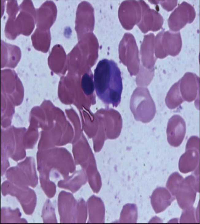 White blood cell showing hypolobulation.