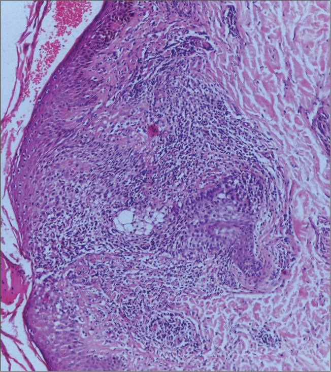 Histopathology showed epidermis with mild acanthosis, epidermotropism, dermis with scattered lymphocytic infiltrate, perivascular lymphocytic infiltrate with coarse fibrosis.