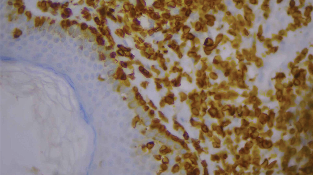 High-power image of immunohistochemistry showing CD3 positivity.