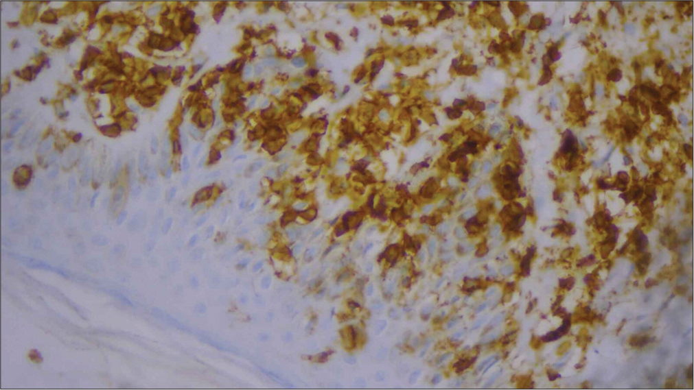 High-power image of immunohistochemistry showing CD5 positivity.