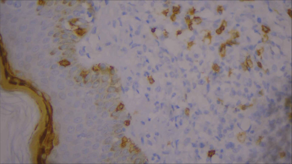 High-power image of immunohistochemistry showing CD8 positivity.