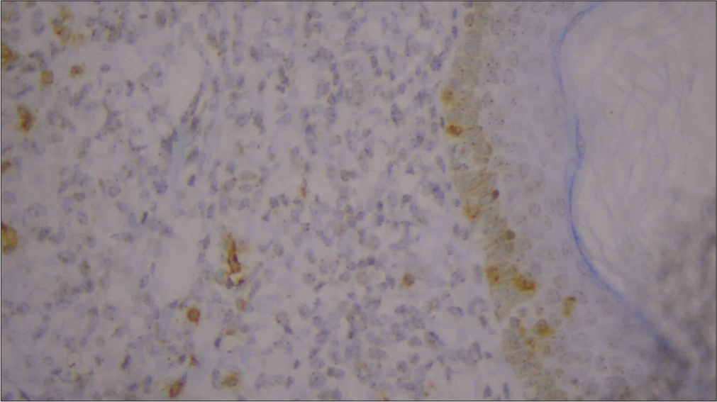 High-power image of immunohistochemistry showing negative CD7.