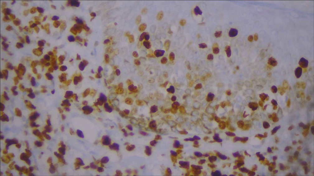 High-power image of Ki-67 immunohistochemistry.