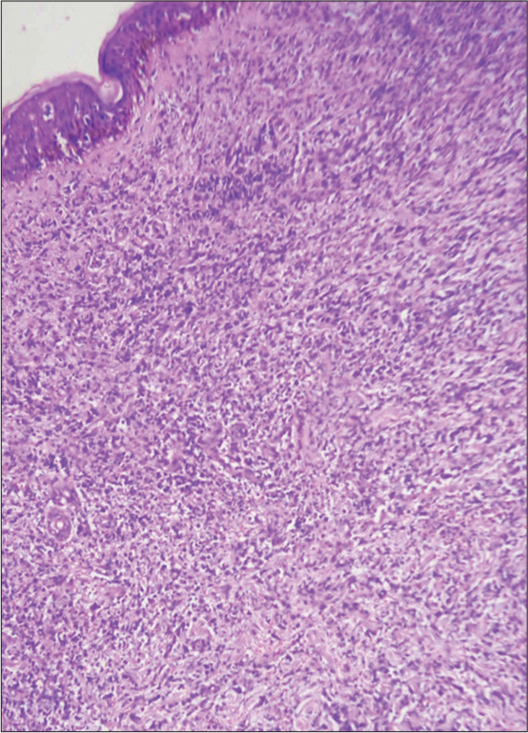 Skin biopsy showing the dermis packed with atypical mononuclear cells, hematoxylin & eosin (H&E) ×200.