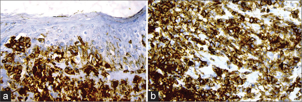 (a): Immunohistochemistry (IHC) showing CD3 positive; (b): CD4 positive cells, ×400.