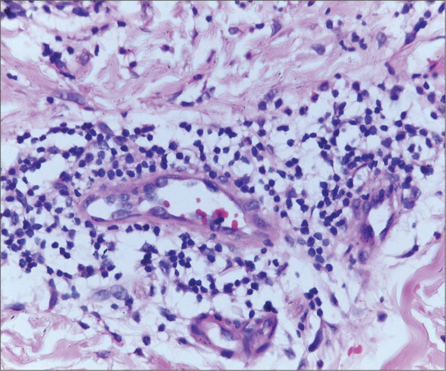 Perivascular infiltrate composed predominantly of neutrophils with few lymphocytes and eosinophils.