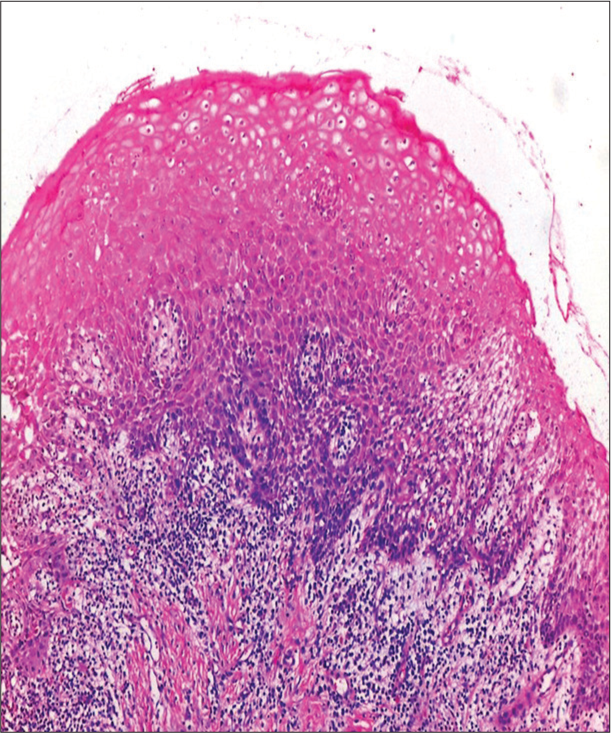 Upper maxillary gingiva shows mild hyperkeratosis, hyperplasia, and focal ulceration.