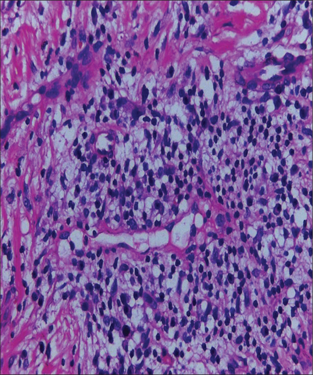 Plasma cell with a characteristic eccentrically placed nucleus and abundant cytoplasm with few lymphocytes.