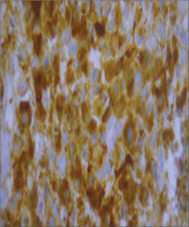 Immunohistochemistry shows CD 138 positive for plasma cells with no evidence of monoclonality of light chains.