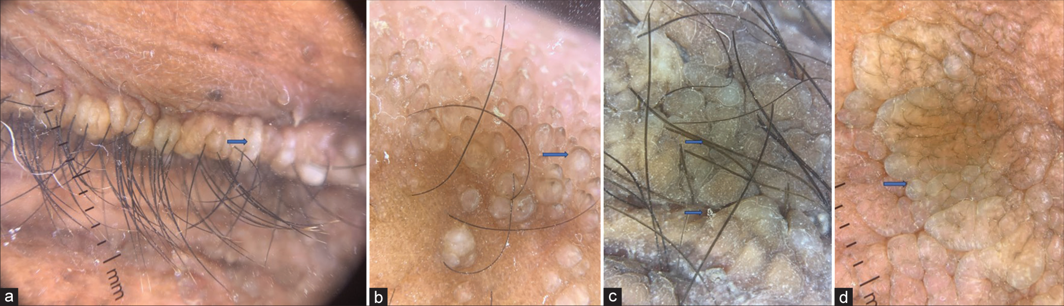 Dermoscopy – DermLite (×10, polarized mode) (a): Eyelids – Multiple whitish-yellow clods in a linear configuration over beaded papules with distichiasis; (b): Pearly beaded globules over the sides of fingers; (c): Axilla-sulci and gyri give a cerebriform appearance; (d): Elbows – Grayish-white rounded structures in clumps giving a pulpy appearance. The blue arrows (a-d) describes the dermatologic findings.