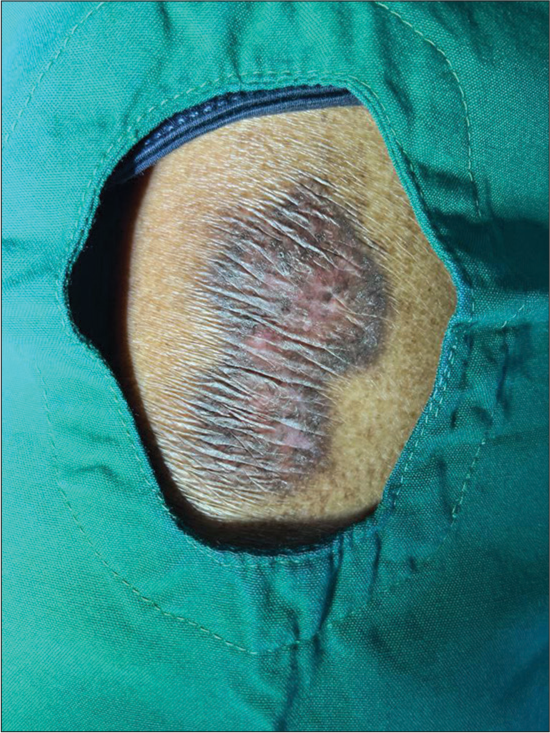 Single hourglass-shaped parchment-like atrophic plaque measuring 7 cm long, 4 cm wide at the widest, and 2.5 cm wide at the narrowest areas with central erythema and surrounding hyperpigmentation over the left gluteal region.