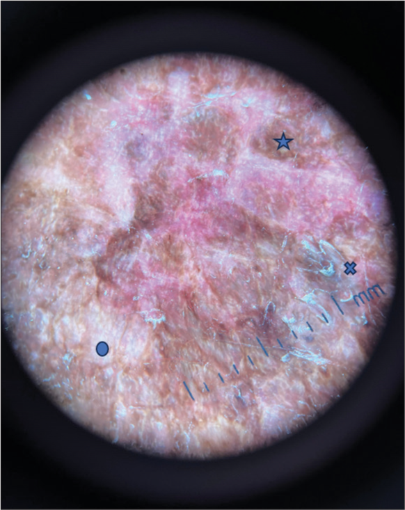 Dermoscopy image showing white structureless areas (circle), perifollicular scaling (cross), hyperpigmentation (star) (Dermaindia M10A30).