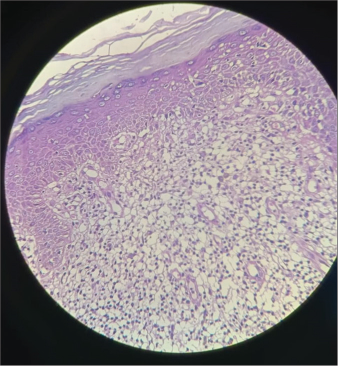Histopathology ×40 image showing hyperkeratosis, basal cell vacuolar degeneration, and pigment incontinence in the epidermis. In the dermis, inflammatory infiltrate is composed of a band of lymphocytes and homogenization of collagen with mild edema.