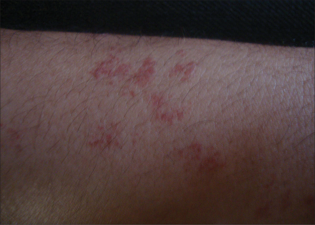 Angioma serpiginosum: Multiple pinpoint coppery red maculopapular eruption on the side of a forearm