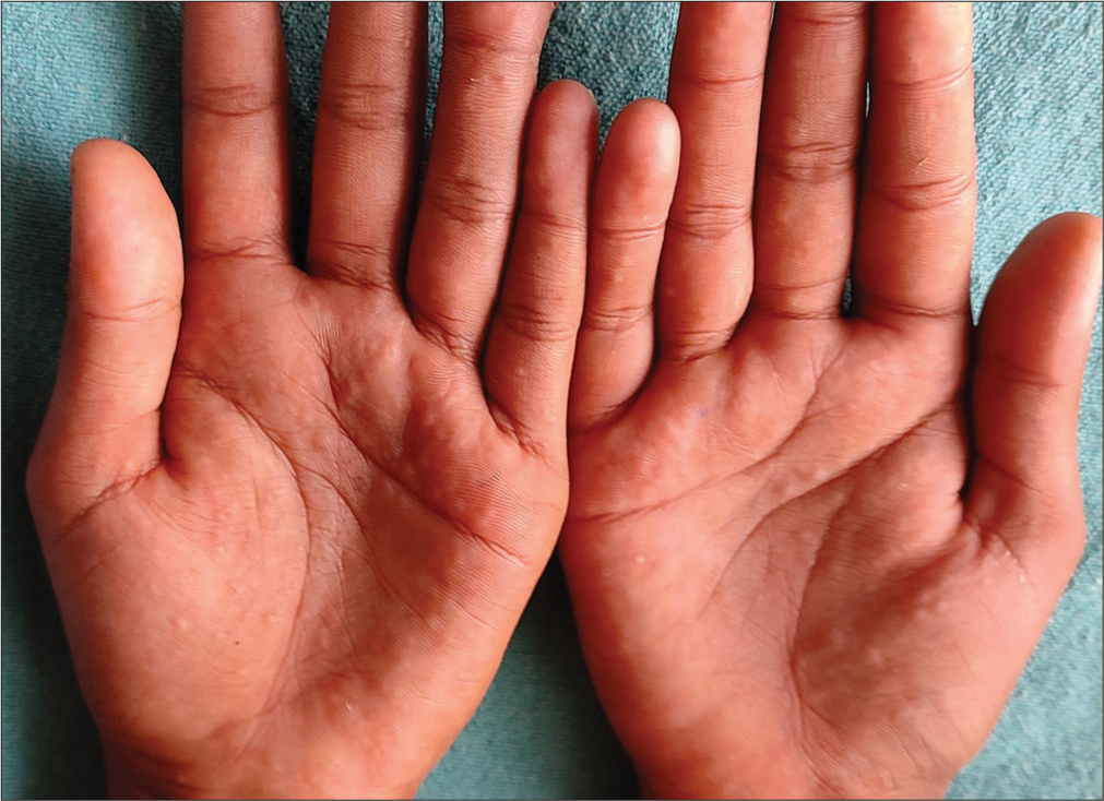 Cheiropompholyx showing confluent vesicles on both palms.