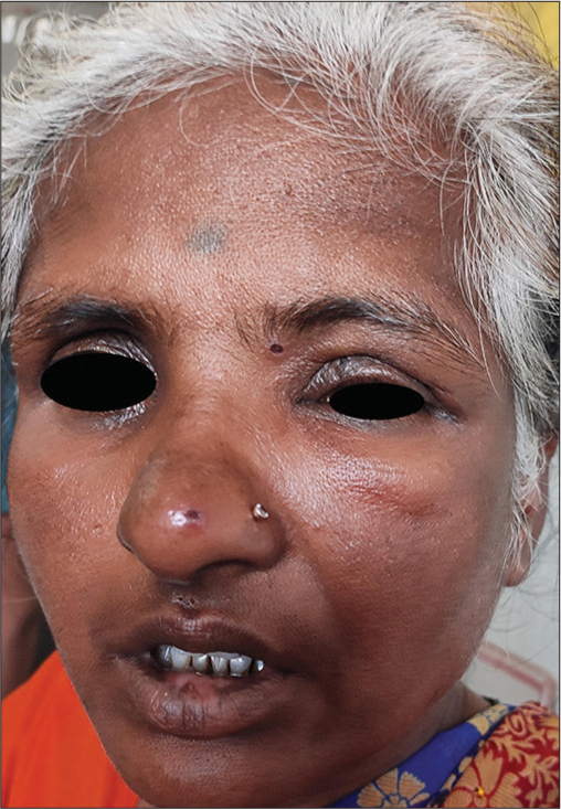 Clinical photograph of herpes ophthalmicus showing vesicle on the tip of the nose.