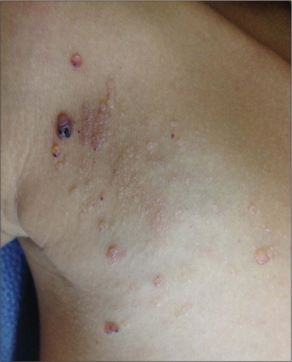 Lymphangioma circumscriptum showing multiple vesicles on the right side of the chest.
