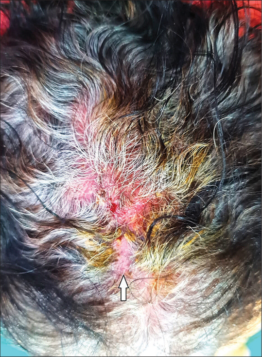 Erythema, erosions, pustules, and crusting with an area of hair loss (arrow) on the frontoparietal region of the scalp.