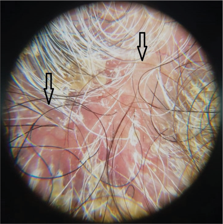 Trichoscopy showing milky red areas with loss of hair follicles (arrow), Dermalite 10, non polarised ×10.