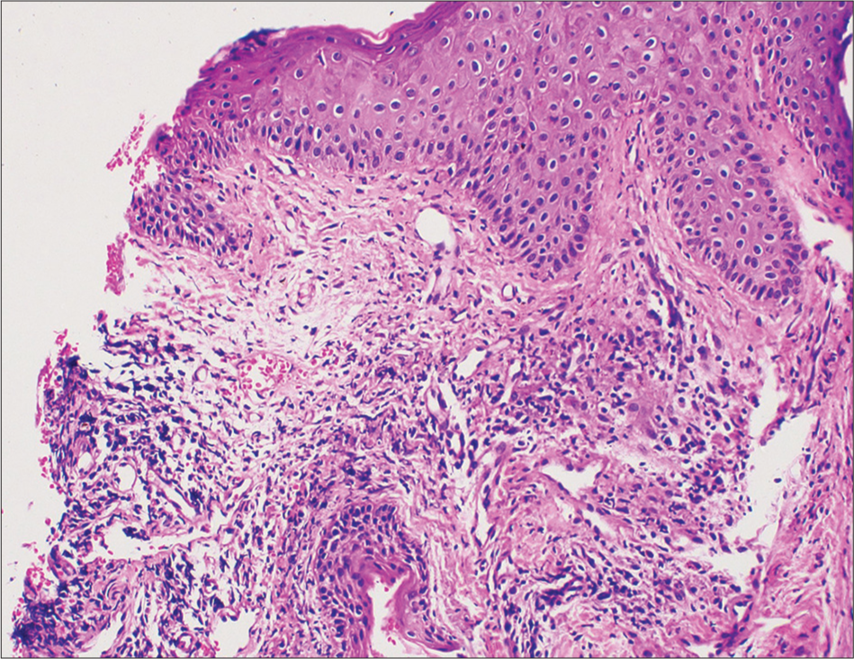 Skin biopsy showing epidermis with mild hyperkeratosis, irregular acanthosis, and ulceration with no hair follicles in the dermis, (H&E ×200).