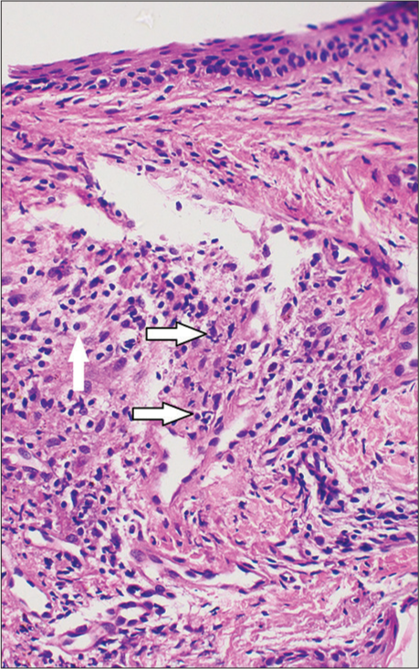 Skin biopsy showing superficial and mid dermis with moderate mixed inflammatory infiltrate composed of lymphocytes, plasma cells (arrow), and neutrophils (arrow), (H&E ×400).