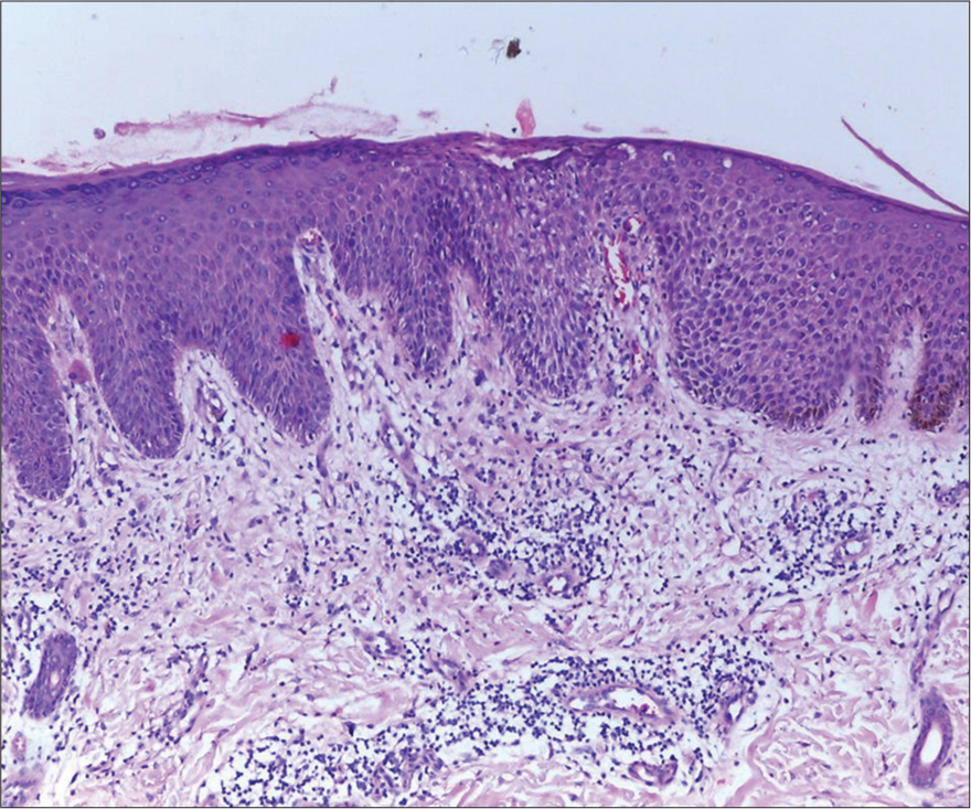 Dermal edema along with diffuse infiltrate composed of predominantly neutrophils with lymphocytes and eosinophils (H&E ×100).