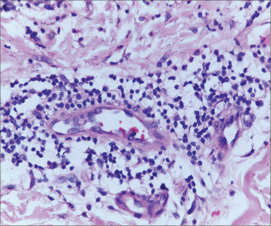 Perivascular infiltrate composed predominantly (H&E ×100) of neutrophils with few lymphocytes and eosinophils.