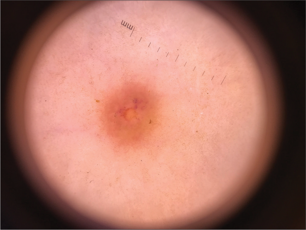 The setting-sun pattern dermoscopy finding of juvenile xanthogranuloma papule (Dermlite 3, ×10).