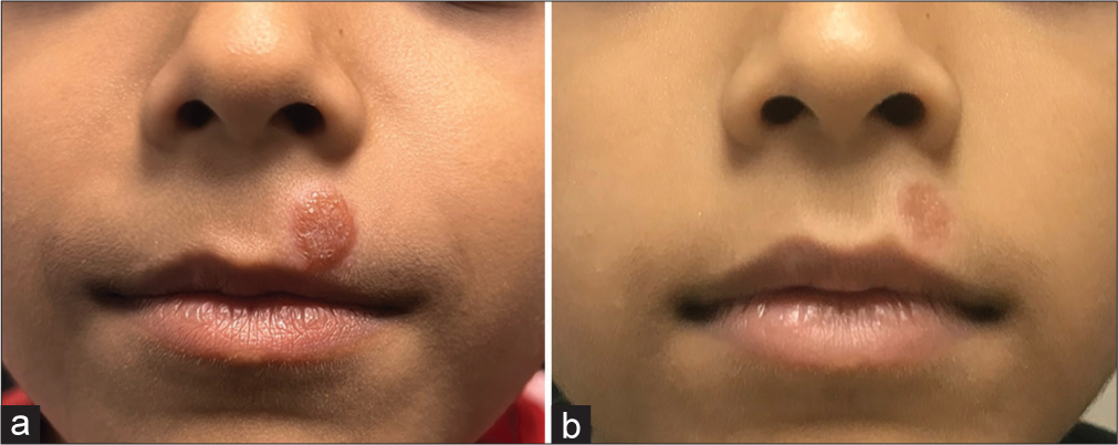 Comparison of pre-treatment and post-treatment features in our case. (a): Tan-orange papules and plaques on the face before treatment. The child was treated with topical 1% rapamycin ointment twice daily for 16 weeks; (b): The skin lesion on the face flattened and faded and reduced in size.