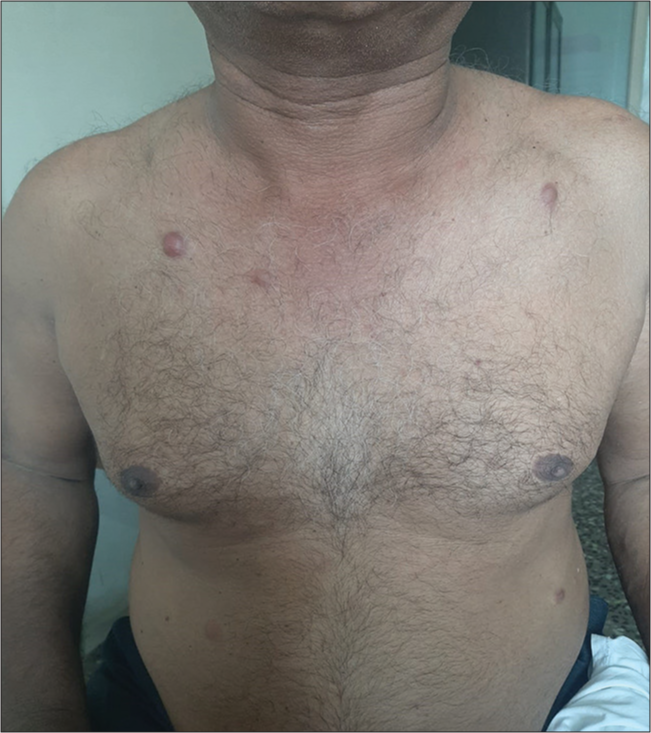 Erythematous plaques and nodules over chest and abdomen.