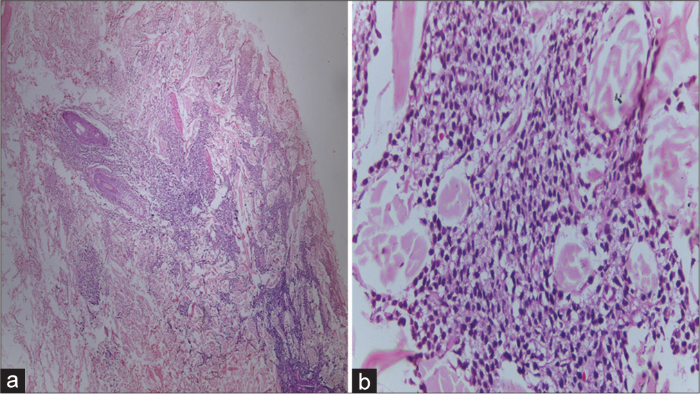(a): Section from skin shows a dense mononuclear cell infiltrate in the dermis arranged in sheets and surrounding the appendages (H&E ×100); (b): Mononuclear cells have moderate cytoplasm and round to oval nuclei, with some showing prominent nucleoli (H&E ×400).