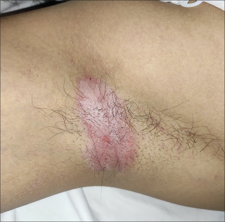 Inverse psoriasis in an adult involving axilla.