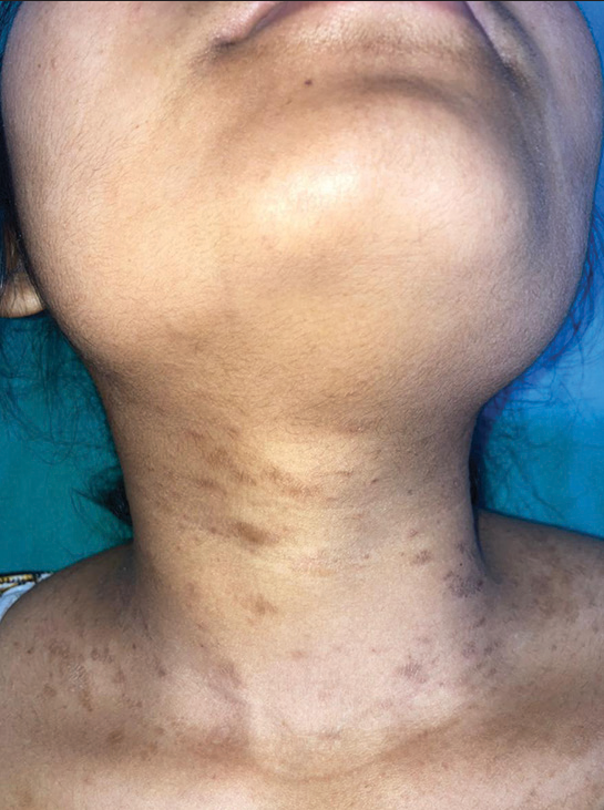 Inverse pityriasis rosea in a young female involving the neck.