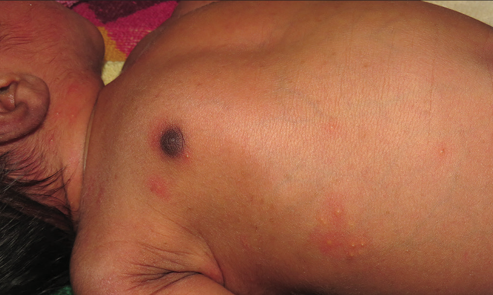 Discrete pustules surrounded by blotchy erythema over the trunk.