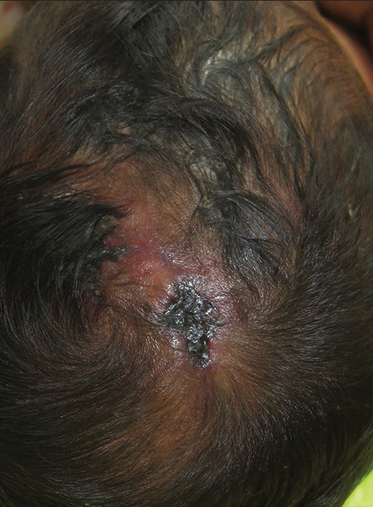 Well-defined ulcer of size 2 × 3 cm over the vertex of the scalp along with alopecia.