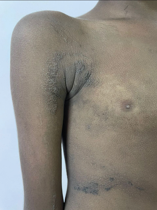 Well-defined hyperkeratotic blaschkoid plaque present over the trunk and the right upper extremity.