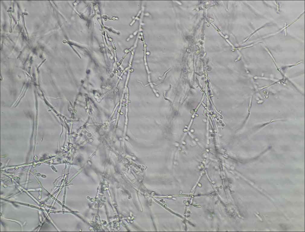 Refractile, long, smooth, branching, septate hyphal filaments, and arthroconidiospores in dermatophytosis.